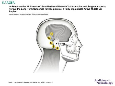 A Retrospective Multicentre Cohort Review of Patient Characteristics and Surgical Aspects versus the Long-Term Outcomes for Recipients of a Fully Implantable.