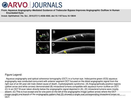 From: Aqueous Angiography–Mediated Guidance of Trabecular Bypass Improves Angiographic Outflow in Human Enucleated Eyes Invest. Ophthalmol. Vis. Sci..