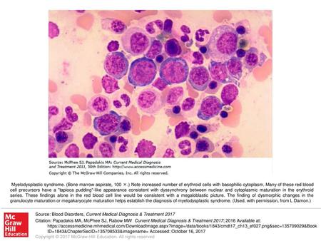 Myelodysplastic syndrome. (Bone marrow aspirate, 100 ×