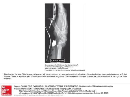 Distal radius fracture