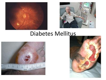 Diabetes Mellitus.