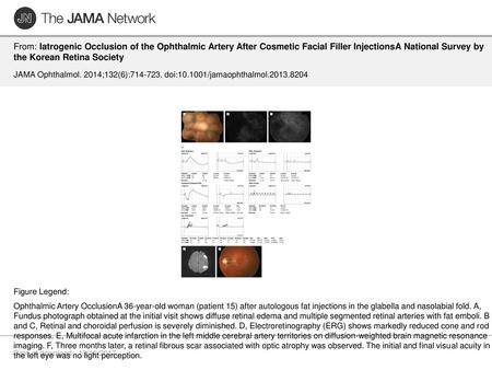 From: Iatrogenic Occlusion of the Ophthalmic Artery After Cosmetic Facial Filler InjectionsA National Survey by the Korean Retina Society JAMA Ophthalmol.