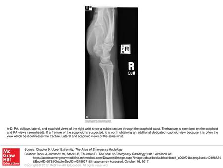 A-D: PA, oblique, lateral, and scaphoid views of the right wrist show a subtle fracture through the scaphoid waist. The fracture is seen best on the scaphoid.