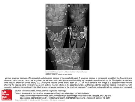 Various scaphoid fractures