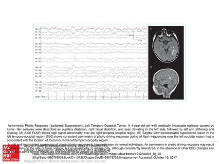 A mild and inconsistent asymmetry of photic driving response is frequently seen in normal individuals. An asymmetry in photic driving response may result.