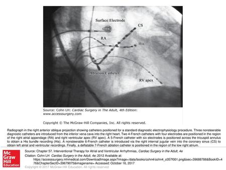 Radiograph in the right anterior oblique projection showing catheters positioned for a standard diagnostic electrophysiology procedure. Three nonsteerable.