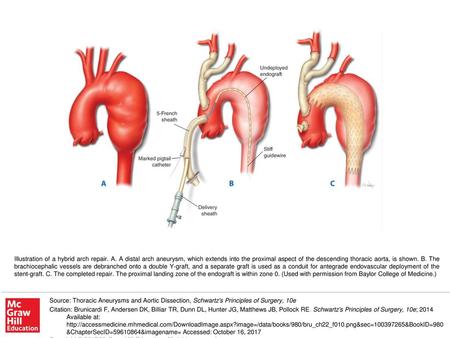 Illustration of a hybrid arch repair. A