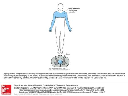 Syringomyelia (the presence of a cavity in the spinal cord due to breakdown of gliomatous new formations, presenting clinically with pain and paresthesias.