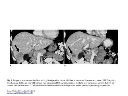 Fig. 8. Response to aromatase inhibitor and cyclin dependent kinase inhibitor in metastatic hormone receptor+, HER2 negative breast cancer. In this 29-year-old.