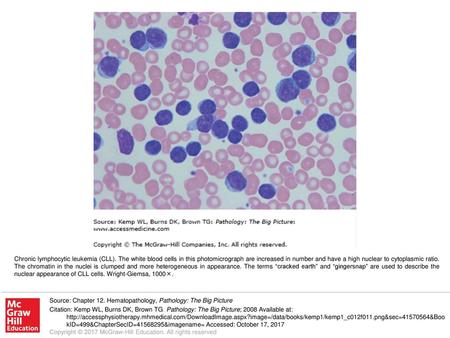 Chronic lymphocytic leukemia (CLL)