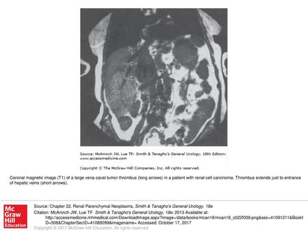 Coronal magnetic image (T1) of a large vena caval tumor thrombus (long arrows) in a patient with renal cell carcinoma. Thrombus extends just to entrance.