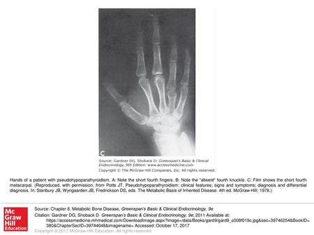 Hands of a patient with pseudohypoparathyroidism