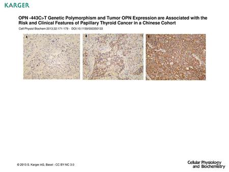 OPN -443C>T Genetic Polymorphism and Tumor OPN Expression are Associated with the Risk and Clinical Features of Papillary Thyroid Cancer in a Chinese Cohort.