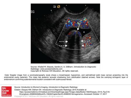 Color Doppler image from a sonohysterography study shows a broad-based, hypoechoic, and well-defined solid mass (arrow) projecting into the endometrial.