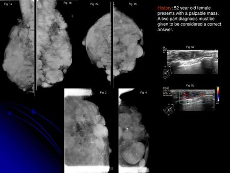 Fig 1a Fig 1b Fig 2a Fig 2b History: 52 year old female presents with a palpable mass. A two part diagnosis must be given to be considered a correct.