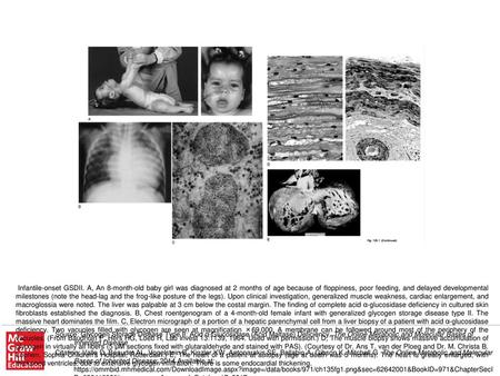 Infantile-onset GSDII