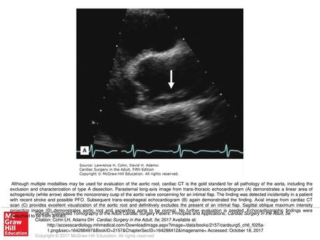 Although multiple modalities may be used for evaluation of the aortic root, cardiac CT is the gold standard for all pathology of the aorta, including the.