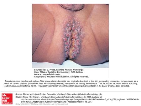 Pseudoverrucous papules and nodules This unique diaper dermatitis was originally described in the skin surrounding urostomies, but can occur as a result.