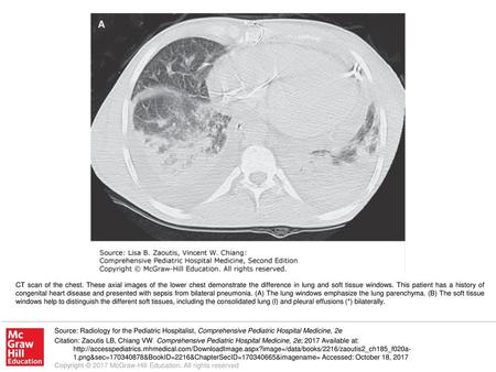 CT scan of the chest. These axial images of the lower chest demonstrate the difference in lung and soft tissue windows. This patient has a history of congenital.