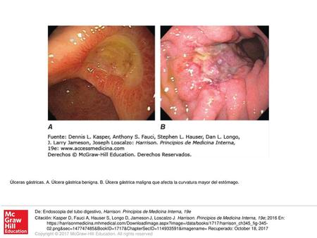 Úlceras gástricas. A. Úlcera gástrica benigna. B