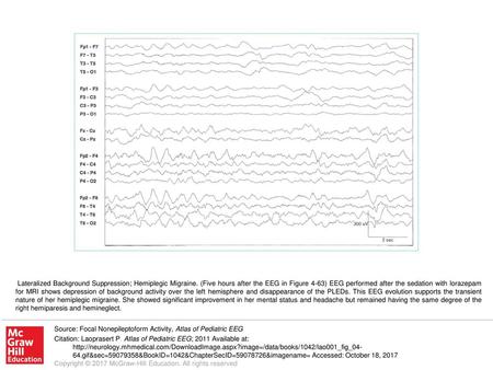 Lateralized Background Suppression; Hemiplegic Migraine