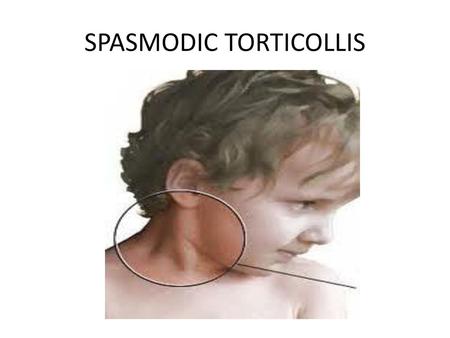 SPASMODIC TORTICOLLIS