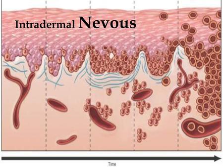 Intradermal Nevous.