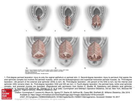 1. First-degree perineal laceration: injury to only the vaginal epithelium or perineal skin. 2. Second-degree laceration: injury to perineum that spares.