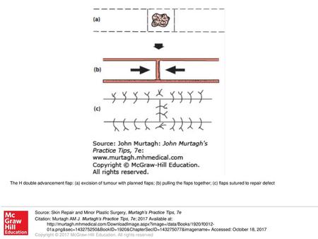 The H double advancement flap: (a) excision of tumour with planned flaps; (b) pulling the flaps together; (c) flaps sutured to repair defect Source: Skin.
