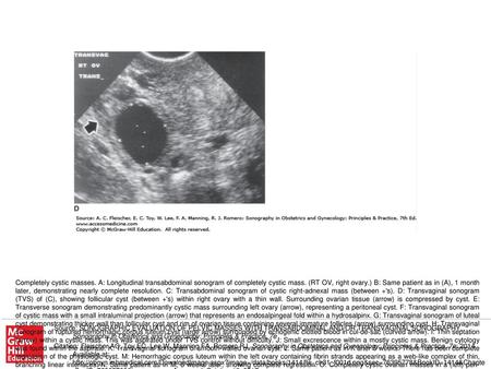 Completely cystic masses