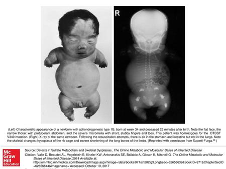 (Left) Characteristic appearance of a newborn with achondrogenesis type 1B, born at week 34 and deceased 25 minutes after birth. Note the flat face, the.