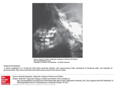 A lateral radiograph of a 13-year-old child shows abnormal dentition, with supernumerary teeth, persistence of deciduous teeth, and impaction of permanent.