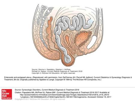 Enterocele and prolapsed uterus