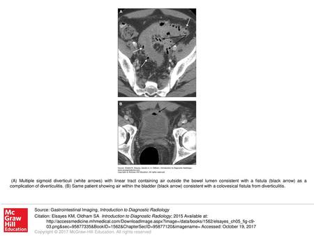 (A) Multiple sigmoid diverticuli (white arrows) with linear tract containing air outside the bowel lumen consistent with a fistula (black arrow) as a complication.