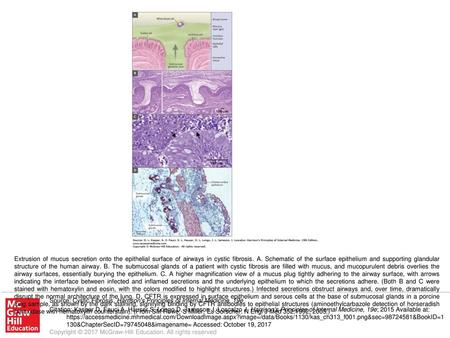 Extrusion of mucus secretion onto the epithelial surface of airways in cystic fibrosis. A. Schematic of the surface epithelium and supporting glandular.