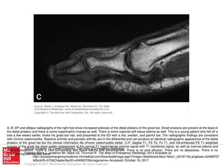 A, B: DP and oblique radiographs of the right foot show increased sclerosis of the distal phalanx of the great toe. Small erosions are present at the base.