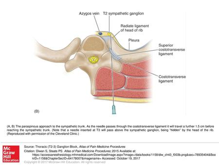 (A, B) The paraspinous approach to the sympathetic trunk