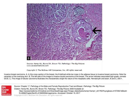 Invasive breast carcinoma