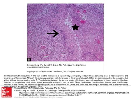 Glioblastoma multiforme (GBM)