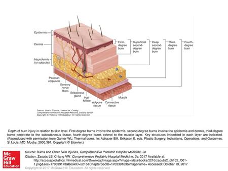 Depth of burn injury in relation to skin level