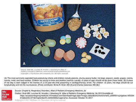 (A) The most commonly aspirated food products by infants and children include peanuts, chunky peanut butter, hot dogs, popcorn, seeds, grapes, raisins,