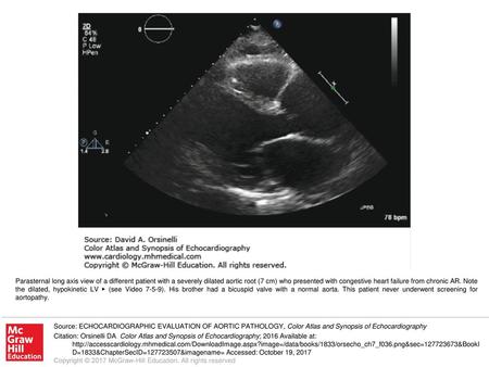 Parasternal long axis view of a different patient with a severely dilated aortic root (7 cm) who presented with congestive heart failure from chronic AR.