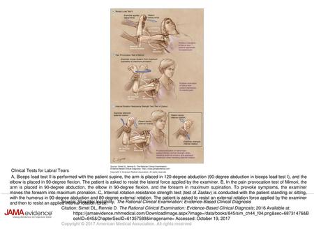 A, Biceps load test II is performed with the patient supine, the arm is placed in 120-degree abduction (90-degree abduction in biceps load test I), and.