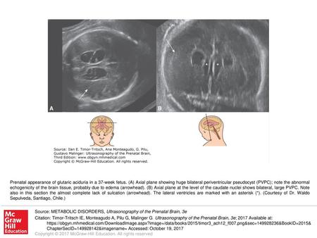 Prenatal appearance of glutaric aciduria in a 37-week fetus