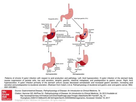 Patterns of chronic H pylori infection with respect to acid production and pathology. Left: Acid hyposecretion. H pylori infection of the stomach body.