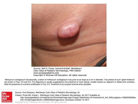 Molluscum contagiosum Occasionally, a lesion of molluscum contagiosum may grow to as large as 3 cm in diameter. Two photos of such “giant mollusca” are.