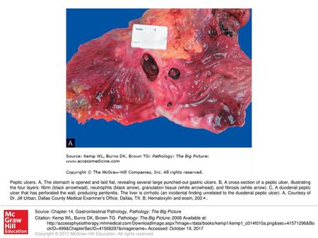 Peptic ulcers. A, The stomach is opened and laid flat, revealing several large punched-out gastric ulcers. B, A cross-section of a peptic ulcer, illustrating.