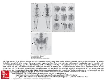 (A) Bone scans of three different patients, each with three different diagnoses: degenerative arthritis, metastatic cancer, and acute trauma. The point.