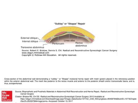 Cross-section of the abdominal wall demonstrating a “sublay “ or “Stoppa” incisional hernia repair with mesh (green) placed in the retrorectus position.