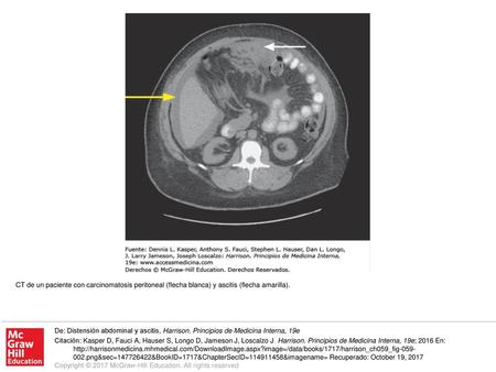 De: Distensión abdominal y ascitis, Harrison